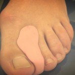 Ortesis de silicona para pies a medida 2