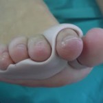 Ortesis de silicona para pies a medida 3